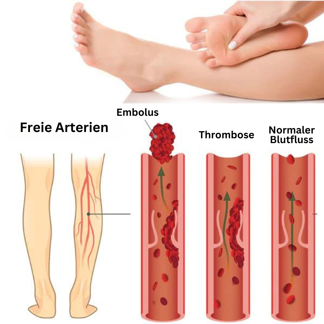 Diagramm der Blutflussstörungen: Embolus, Thrombose, normale Arterien, Fußmassage.