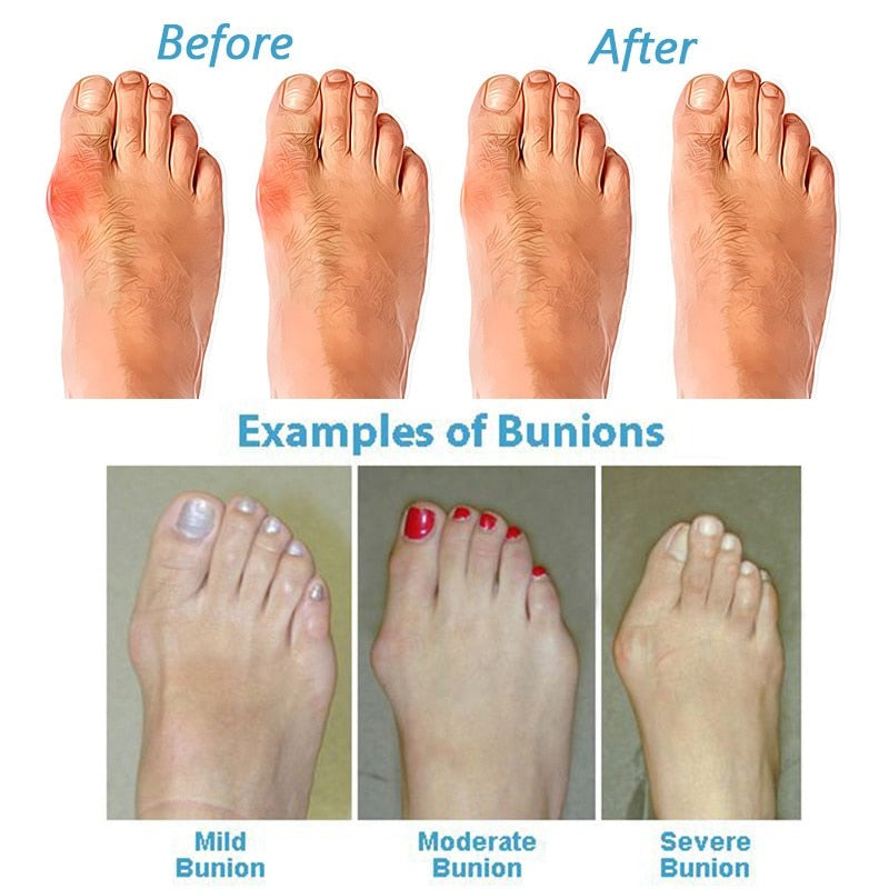 Vorher-Nachher-Bild von Hallux Valgus, Beispiele für milde, moderate und schwere Ballenzehen.