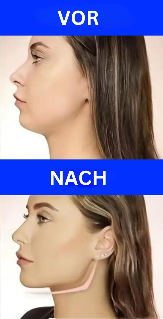 Vorher-Nachher-Bild Kinnstraffung, Frau, Kieferlinie, Gesichtskontur, Schönheitsbehandlung